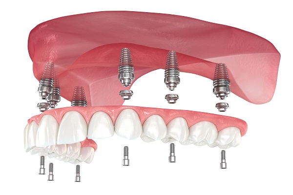 The Advantages Of Implant Supported Dentures Over Regular Ones